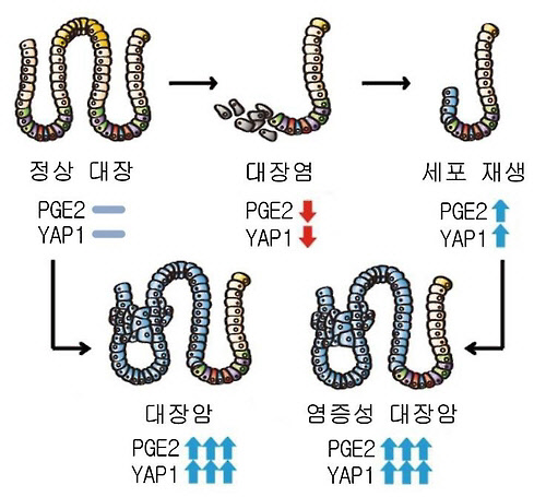 새로 발견된 대장암 발병 기전[서울아산병원 제공=연합뉴스]